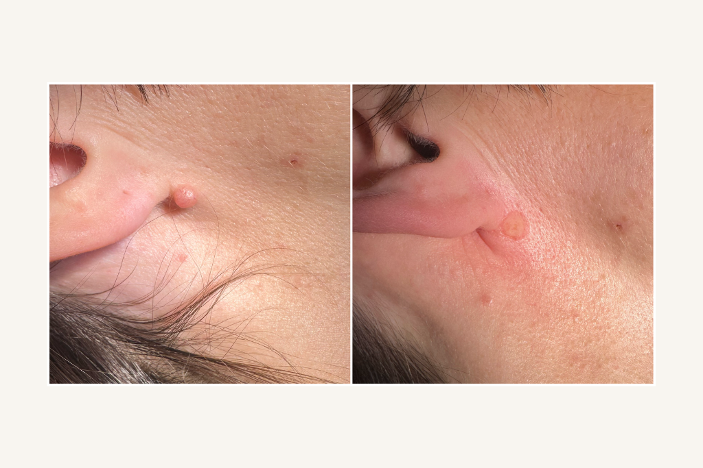 Laser mole removal