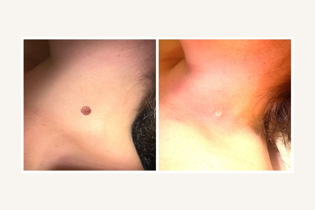 Laser removal of moles