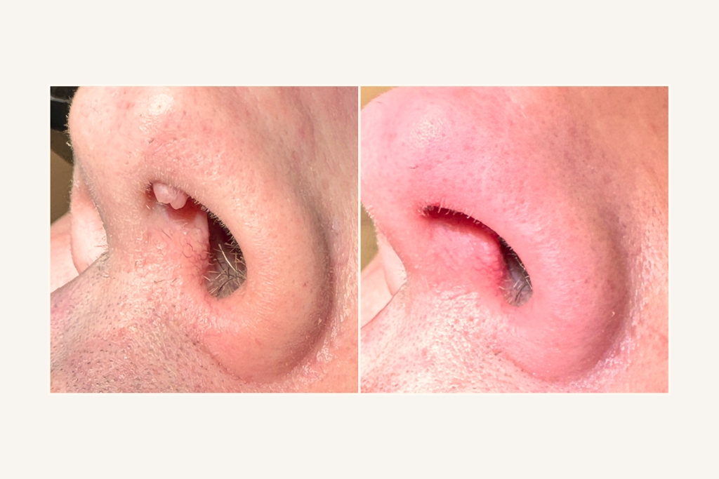 Laser removal of moles