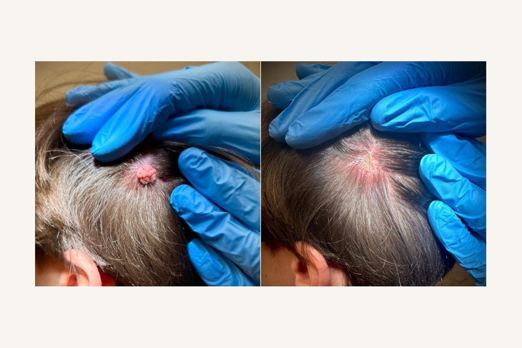 Laser removal of moles