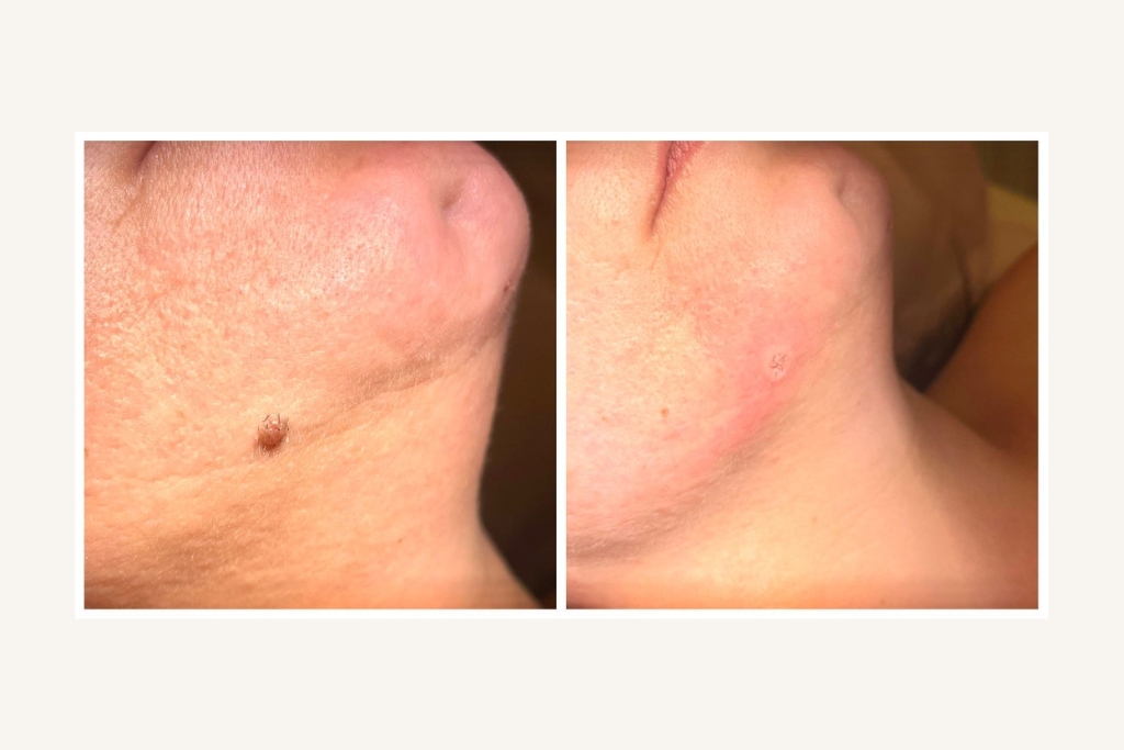 Laser removal of moles