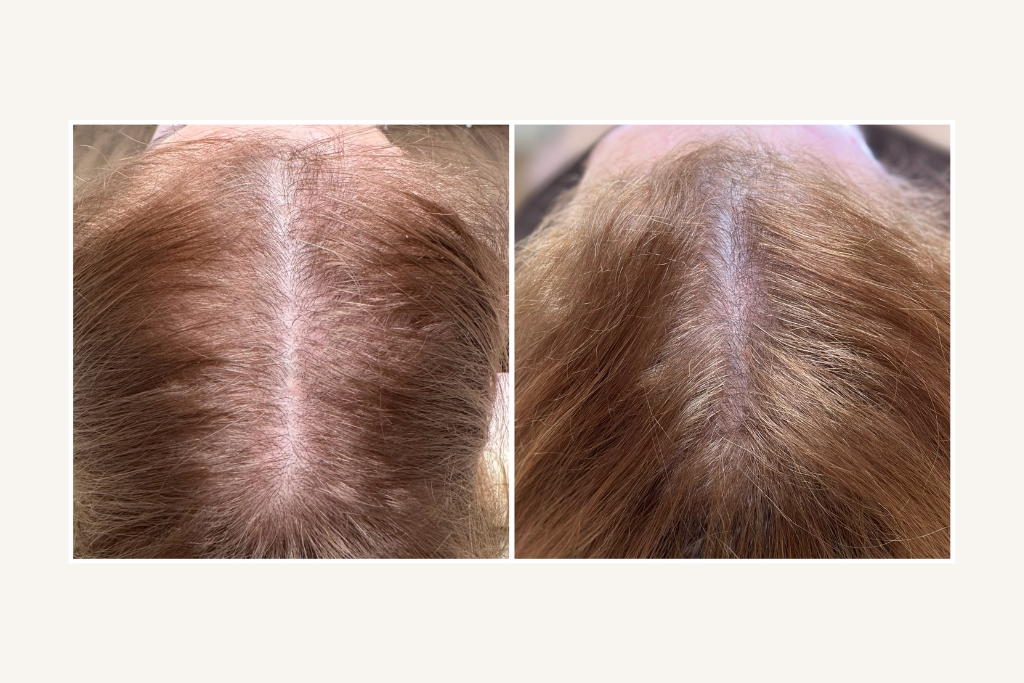Hair before and after 4 PRP sessions