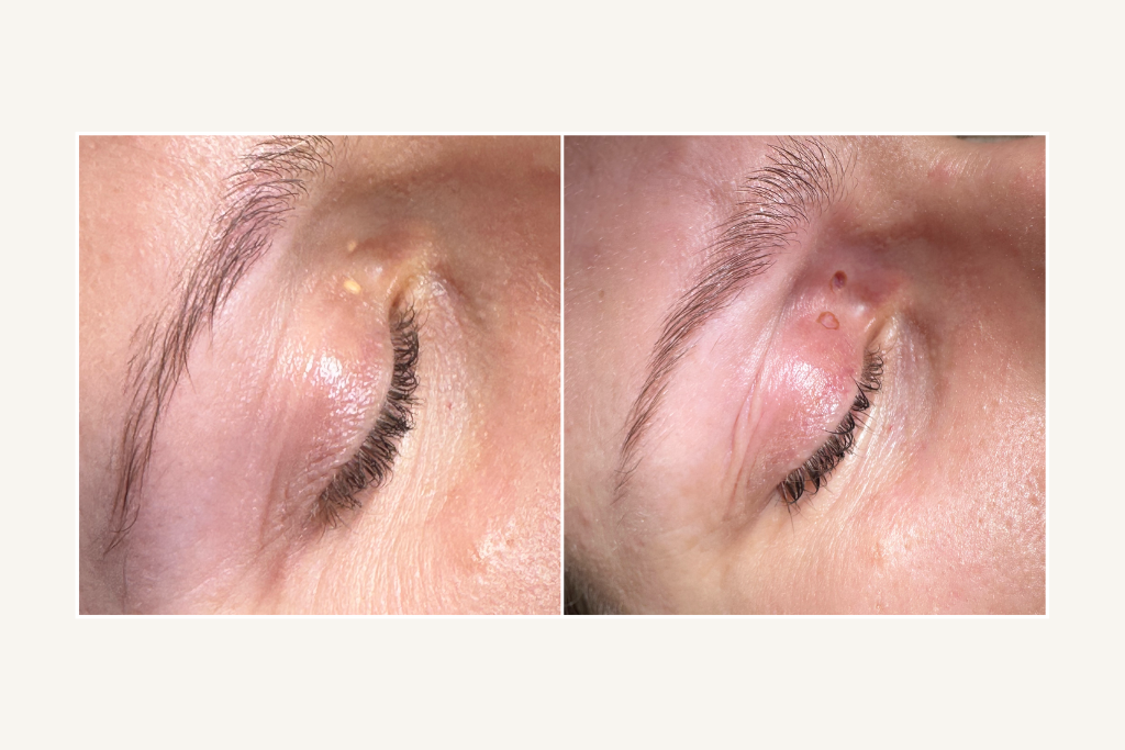 Laser removal of xanthelasma