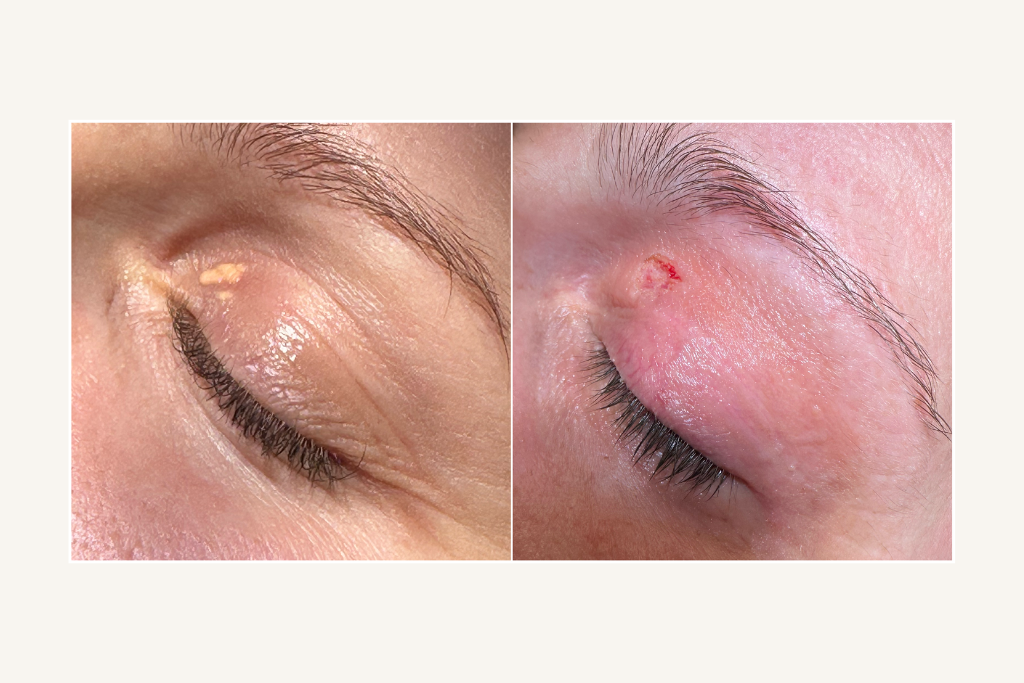 Laser removal of xanthelasma