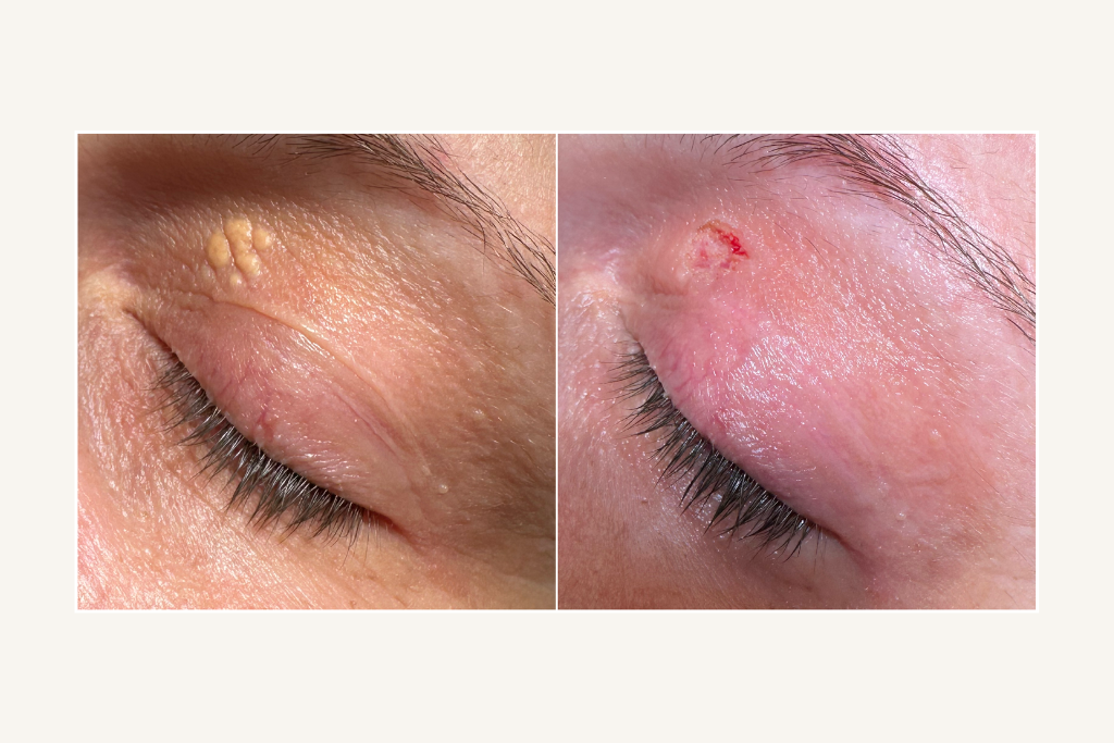 Laser removal of xanthelasma