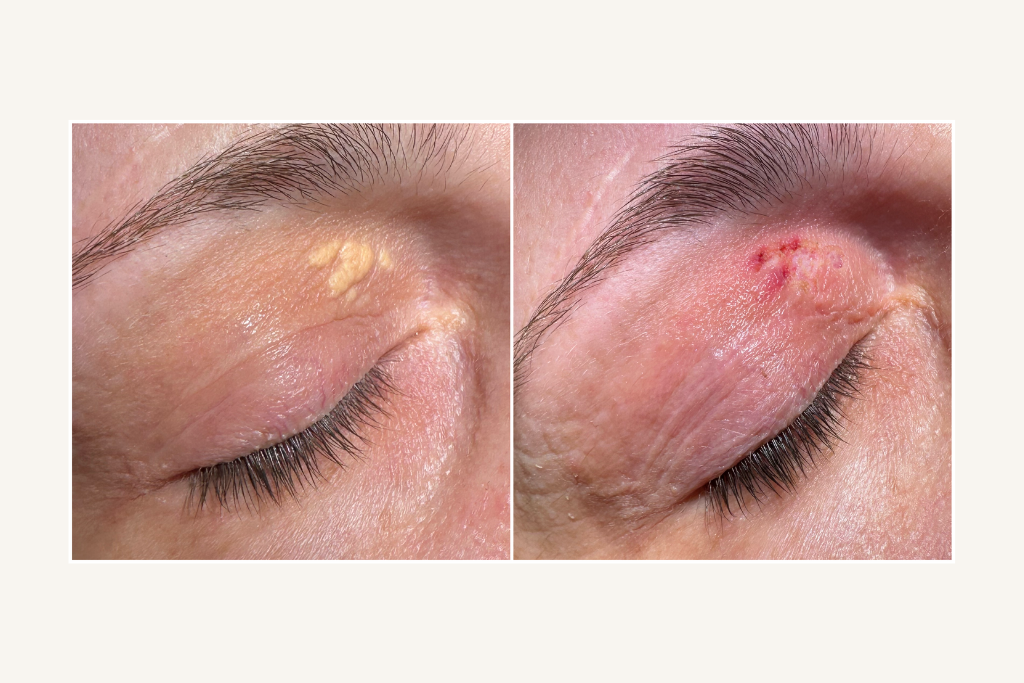 Laser removal of xanthelasma