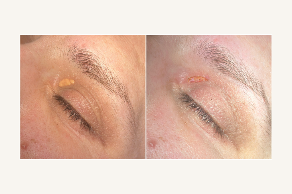 Xanthelasma before and after the laser removal procedure 