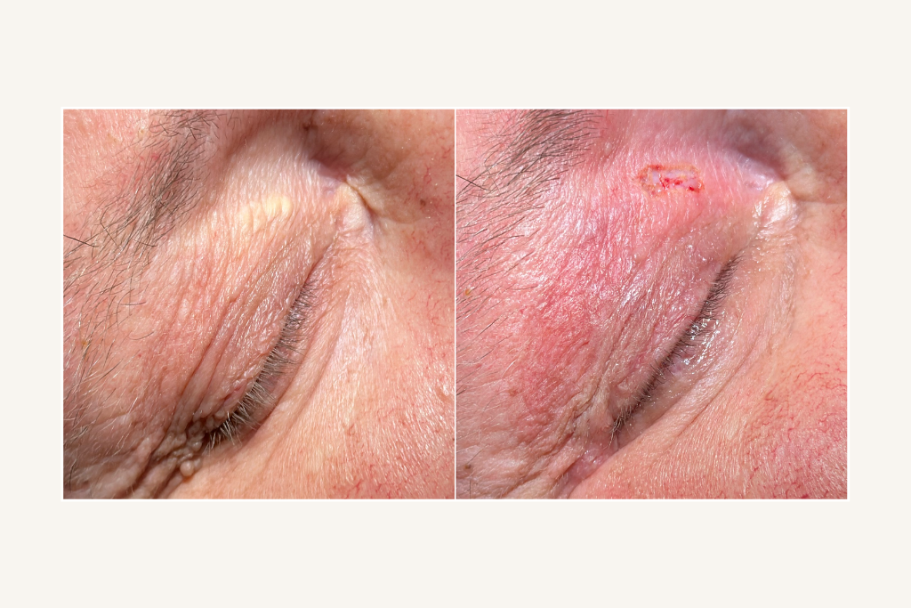 Xanthelasma before and after the laser removal procedure 