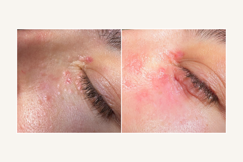 Syringomas before and immediately after laser removal.