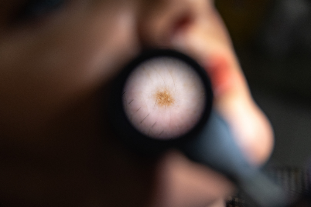 Odos darinio vaizdas per dermatoskopą