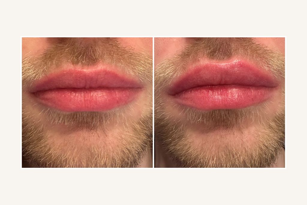 Lip shape correction with hyaluronic acid fillers